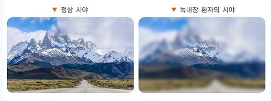 정상 시야(왼쪽)와 녹내장 환자의 시야(오른쪽) 비. /사진=국가건강정보포털
