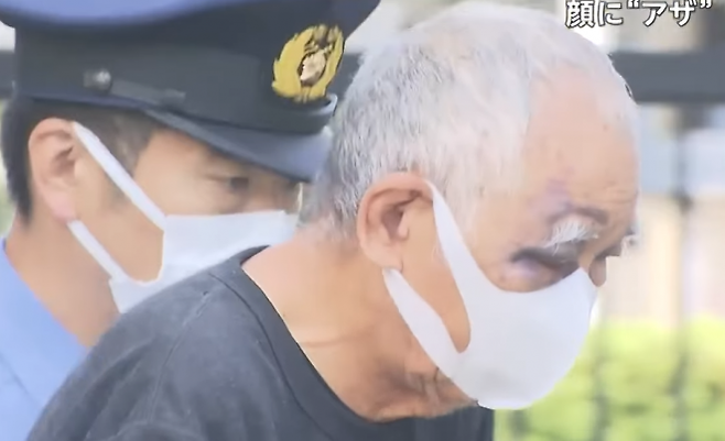 일본 지바현경 후나바시히가시서는 살인미수 혐의로 지바현 후나바시시에 거주하는 후루타니 다카노부(76)를 지난 3일 체포했다. 사진은 후루타니 얼굴에 아들에게 폭행당해 생긴 것으로 추정되는 멍이 남아있는 모습. 후지TV 보도화면 캡처