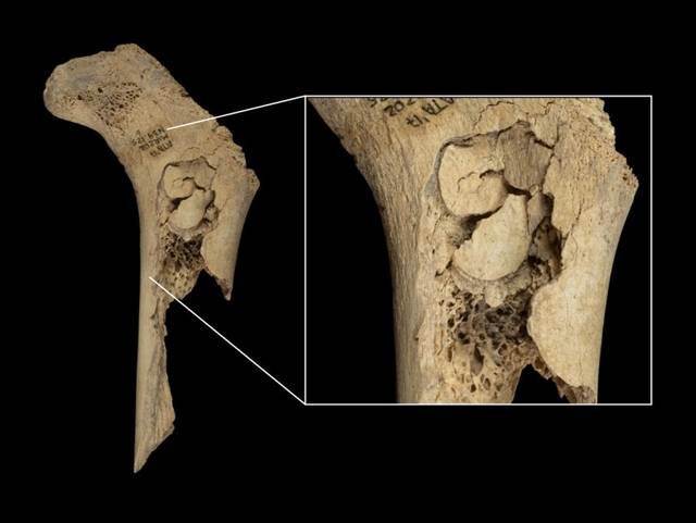 스페인 엘 미라도르(El Mirador) 동굴에서 발견된 유아 대퇴골로, 뼈를 깨뜨려 골수를 추출한 흔적이 있다. IPHES-CERCA 제공