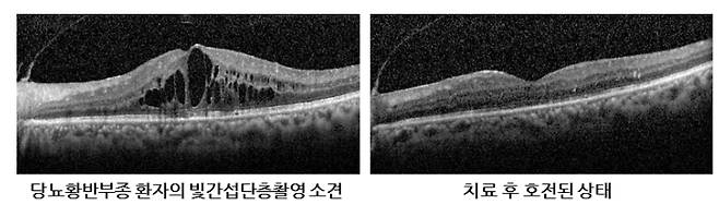당뇨황반부종 환자의 빛간섭단층촬영 검사 결과(왼쪽), 치료 후 호전된 상태(오른쪽). /사진=서울아산병원