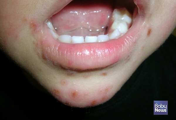 수족구병 환자수가 5월 이후 지속적으로 늘고 있으며 특히 0~6세는 7~18세보다 발생률이 더 높은 양상을 보이고 있다. ⓒ베이비뉴스