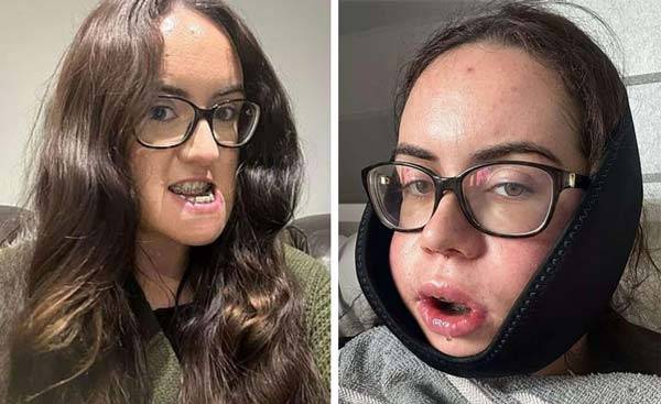 부정교합을 치료하기 위해 양악수술을 받은 뒤, 겪은 각종 고통과 부작용에 대해 고백한 루이사 맥더모트의 수술 전(왼)과 후(오)/사진=데일리메일