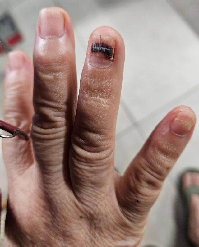 3개월 전 짜장면 만드는 기계에 말려 들어간 뒤 흉터가 남은 박 목사의 손.