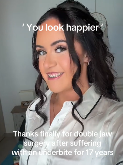 영국에서 주걱턱으로 고통받던 20대 여성이 장기간의 교정과 수술 끝에 외모와 자신감을 되찾은 사연이 알려져 눈길을 끌고 있다. 사진은 수술 후 모습. 틱톡 캡처