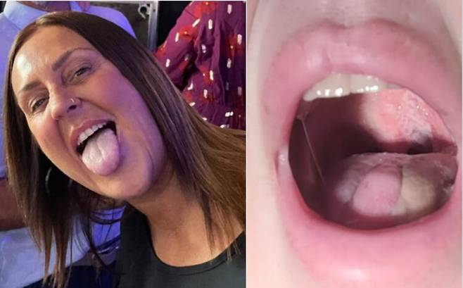 혀에 생긴 작은 흰색 병변을 이상없다 여기고 20년간 방치하다 결국 혀의 절반을 절제하는 수술까지 이어진 사례가 전해졌다. 사진=SNS