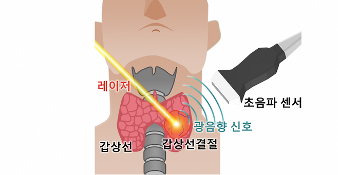 레이저로 갑상선 결절에 광음향 신호를 발생시키고 초음파 센서로 광음향 신호를 획득하는 모식도. 포스텍 제공.
