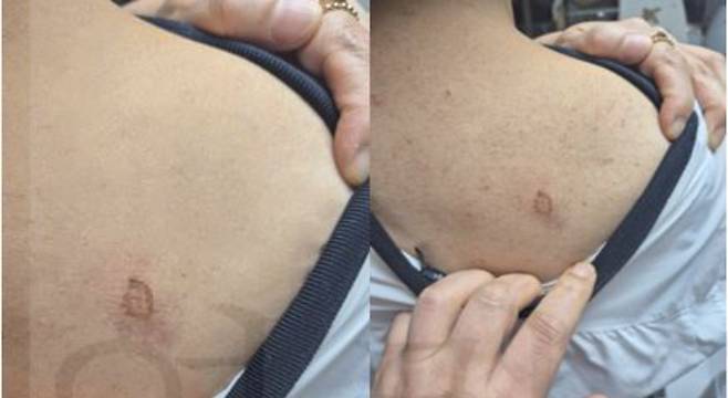 A씨는 "마찰 화상을 입고 다른 소비자들도 피해를 겪을 것이 우려돼 곧바로 고객센터에 알렸지만, 업체 측은 이같은 결함을 인지하고도 판매 중지나 개선은 커녕 홍보 및 판촉을 강화했다"고 분통을 터뜨렸다. 사진은 A씨가 공개한 부상 사진. A씨 제공