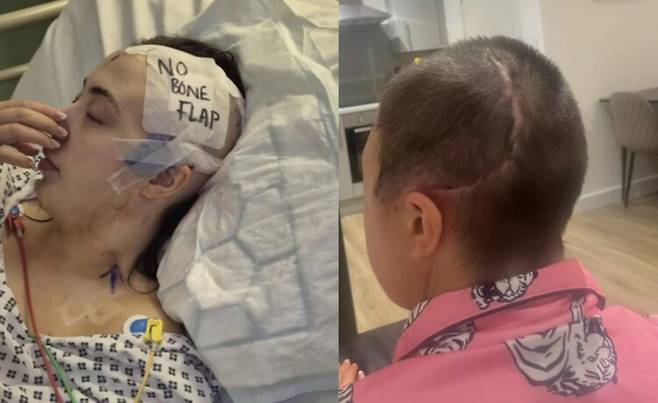 점술사가 술 조심하라고 경고한 지역에서 술자리 후 화장실 문을 잘못 열어 지하실로 추락해 두개골 절반을 절제하는 대수술을 받은 한 여성의 사연이 전해졌다. 사진=로퍼 SNS /뇌 손상 환자 지원 단체