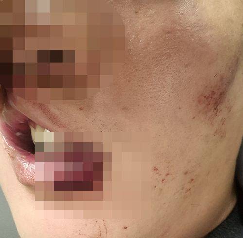 체포 과정에서 다친 얼굴. 연합뉴스, 독자 제공