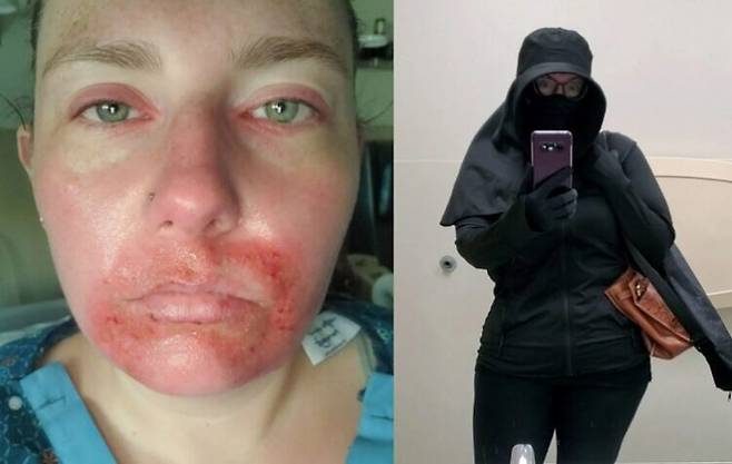 희귀피부질환 스티븐스 존스 증후군 진단을 받은 에밀리 리처드슨. 사진=고펀드미