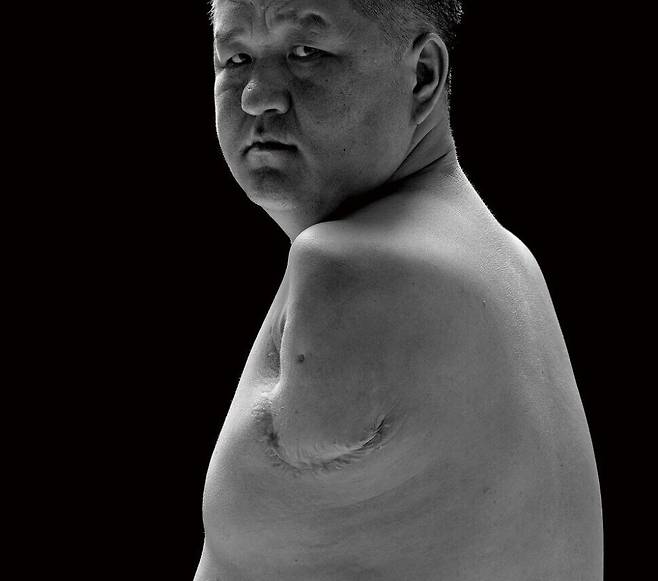 중증화상 산재로 양팔을 절단한 몽골 출신 이주노동자 오기나. 김진수 선임기자