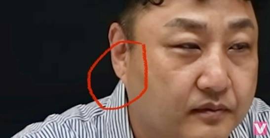 한 네티즌이 김수용의 귓볼에 프랭크 징후가 있었다고 주장했다. 유튜브 ‘비보티비’ 캡처