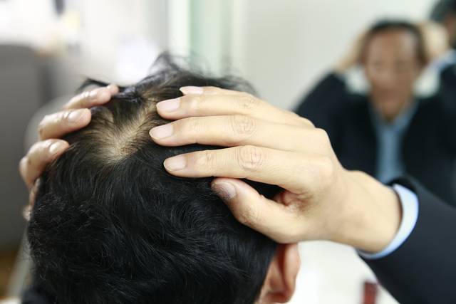 탈모의 원인은 유전뿐 아니라 스트레스, 다이어트, 잘못된 식습관이나 생활 습관 등 아주 다양하다. 초기 증상이라고 의심되면 생활 습관을 확인해보는 것이 중요하다. 사진은 기사의 특정 사실과 관련 없음. 클립아트코리아