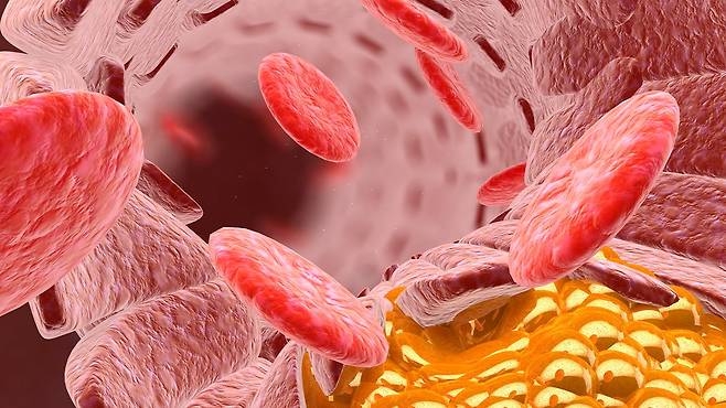 젊은 나이에 시작된 고지혈증은 그만큼 혈관 손상이 일찍부터 누적된다고 볼 수 있다|출처: 클립아트코리아