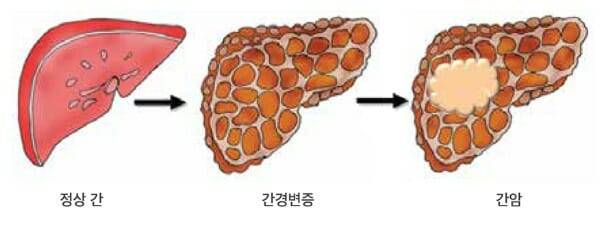 간암 진행 과정(사진=대한간암학회)