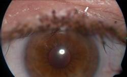 50대 남성의 눈꺼풀에서 사면발이가 발견된 사례가 보고됐다. 피부과 온라인 저널(Dermatology Online Journal) 캡처