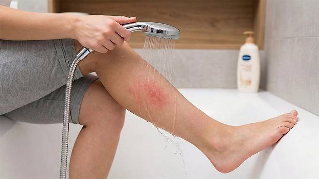 저온화상 발생 시 빨리 시원한 물로 열을 식히고, 피부과에서 손상의 깊이를 확인해야 한다|출처: Gemini