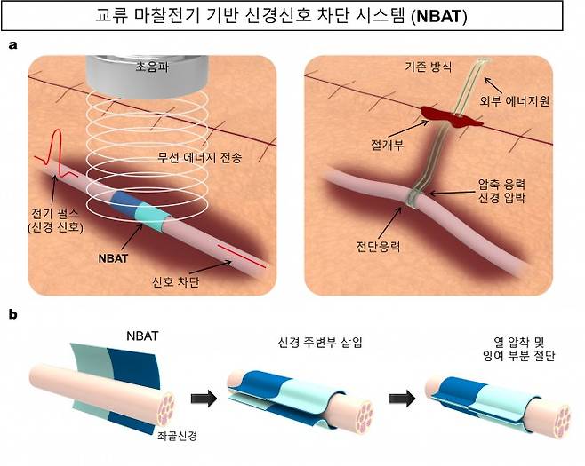 연세대, 삼성서울병원 공동연구팀이 개발한 교류 마찰전기 기반 신경신호 차단 시스템(NBAT) 개념과 적용 구조. 초음파를 가하면 신경을 감싼 NBAT에서 마찰전기가 생성돼 신경 신호가 차단되는 원리다. 기존 방식에서 나타나는 부작용에 대한 우려를 줄였다. 유연한 고분자 기반 재료로 구성돼 기계적 압박 없이 안정적으로 고정된다. 연세대 제공