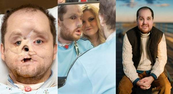 지난 2024년, 학업 스트레스를 견디지 못하고 스스로 생을 마감하려다 얼굴에 심각한 손상을 입은 미국 남성이 안면 인식 수술을 받고 새 삶을 찾았다./사진=메이요 클리닉