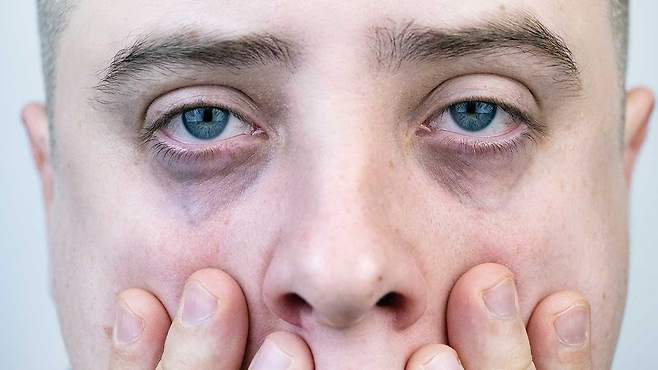 다크서클, 어떻게 해결 해야 할까?|출처: 게티이미지뱅크