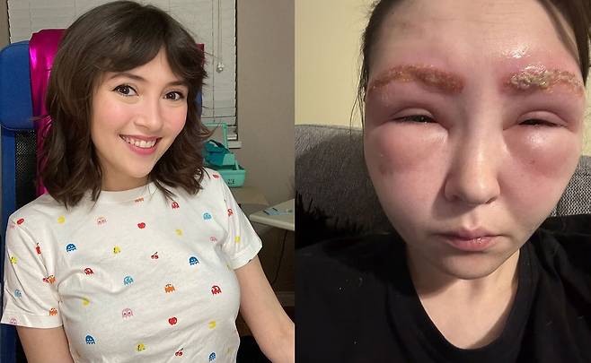 캐나다의 한 여성이 눈썹 염색 시술을 받은 뒤 얼굴이 외계인처럼 부풀어 올라 화제가 됐다./사진=데일리메일
