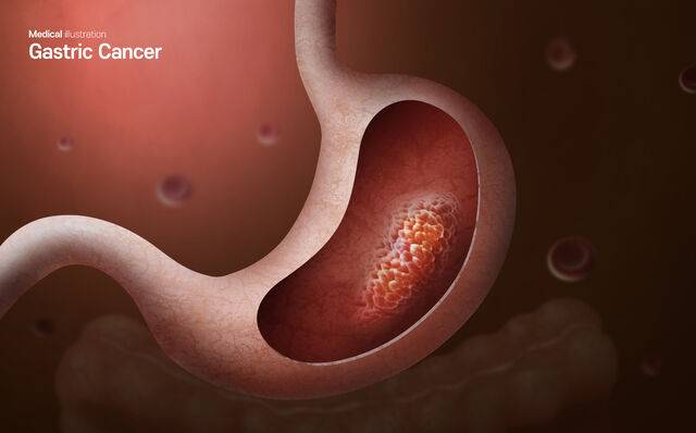 29일 분당서울대병원은 위암 면역항암제 효과가 남성에서 더 높았다는 내용의 연구 결과를 내놨다. 클립아트코리아