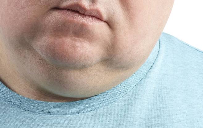 이중턱 지방흡입 수술 후 부적절한 관리로 심각한 부작용을 입은 20대 남성의 사례가 보고됐다./사진=클립아트코리아