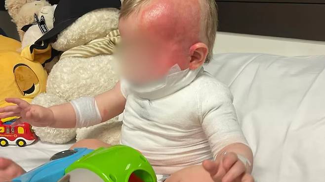 2024년 9월 호주 퀸즐랜드주 브리즈번의 핸론 공원에서 가족들과 피크닉을 즐기다 한 중국인 남성이 부은 뜨거운 커피로 화상을 입은 아기의 모습. 사진은 아기 가족이 호주 언론에 제공한 사진. /사진=호주 공영방송 ABC