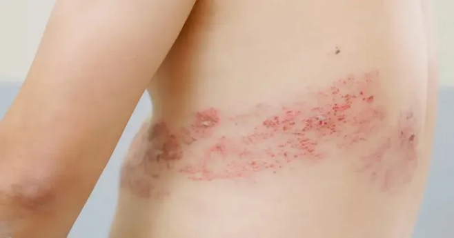 대상포진은 띠 모양의 발진과 함께 해당 부위의 극심한 신경통이 나타나는 증상을 보인다. 게티이미지