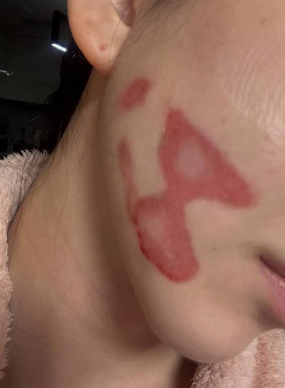 권민아 피부 리프팅 시술 후 사진 (권민아 인스타그램 캡처)