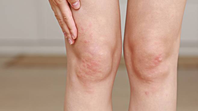 재발과 호전을 반복하는 무릎 건선, 근복부터 해결하는 것이 좋다|출처: 클립아트코리아