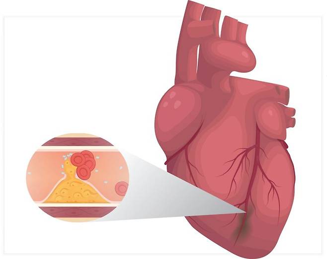 심근경색 개요. 서울대병원 제공