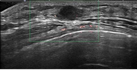 조기 유방암 환자의 초음파 검사 사진