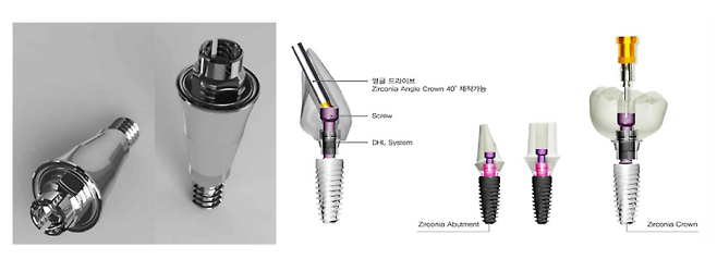 치과용 접착제(시멘트)를 쓰지 않고 기계적 결합으로 고정하는 방식의 임플란트. (제공=시지메드텍)