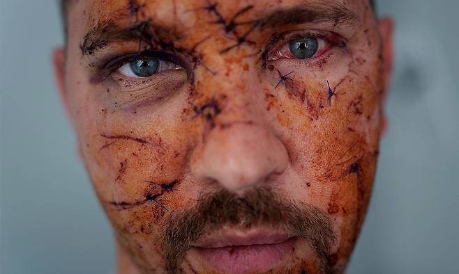 2025년 4월 25일(현지시간) 러시아 공습으로 얼굴 여러 군데에 상처를 입은 주민이 카메라를 응시하고 있다. AP연합뉴스