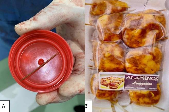 필리핀 60대 남성이 소시지 꼬치(오른쪽)를 먹다가 꼬치 막대기를 모르고 삼켜 소장에 구멍이 나는 사고를 겪었다. 왼쪽은 남성의 몸에서 나온 꼬치. 사진=외상·증례 보고(Trauma Case Reports)