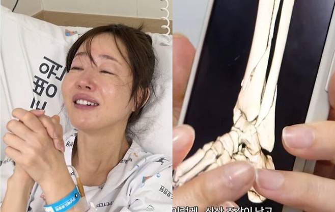 배우 엄지원이 일본 여행에서 다리 골절 사고를 입어 긴급 수술을 받았다. 사진=유튜브 채널 '엄지원 Umjeewon'