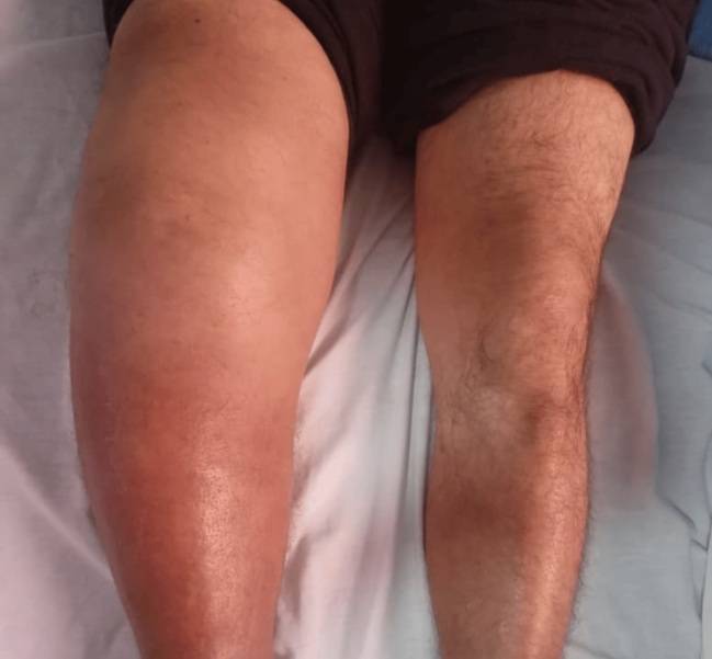 매독성 관절염으로 한쪽 다리가 퉁퉁 부어오른 모습. 사진=큐레우스(Cureus)