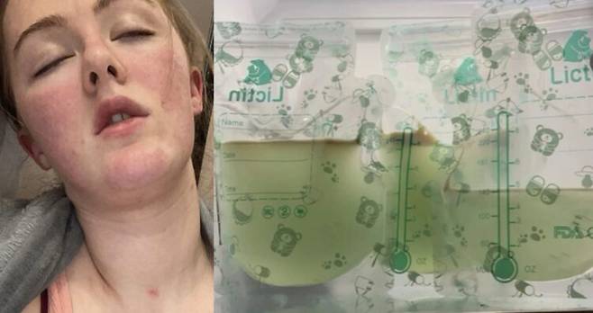 알레르기 병력이 없던 30대 여성이 새벽에 갑작스러운 복통과 함께 쓰러져 병원으로 이송된 뒤 희귀 면역질환을 진단받았다. 사진=SNS