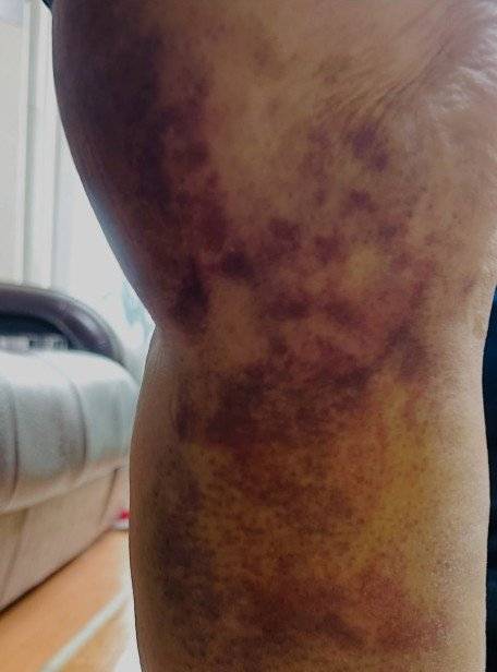 서울 지하철 5호선 김포공항역에서 발빠짐 사고를 당한 80대 A 씨의 다리 부위에 심한 멍이 든 모습. 사진=제보자 제공