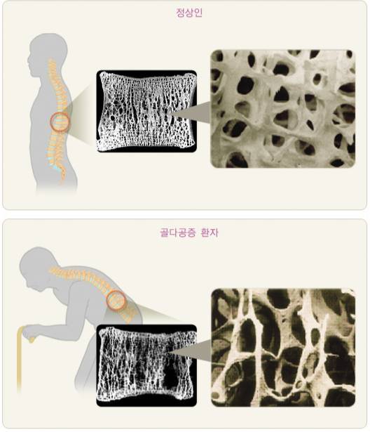 정상인(위)과 골다공증 환자(아래)의 뼈. /자료=대한골대사학회