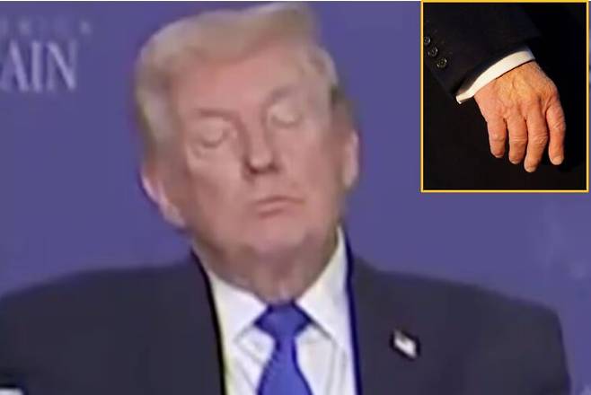 지난 3월 23일 미국 멤피스에서 열린 원탁회의에 참석한 도널드 트럼프 대통령의 영상이 온라인에서 확산되면서, 또 건강 이상설이 나왔다. 상단 사진은 트럼프 대통령 손등의 멍. 잦은 악수와 아스피린 복용으로 인한 자극이 원인이라는 설명이 나왔다. 사진=X(옛 트위터)에서 확산되고 있는 영상 캡처 편집