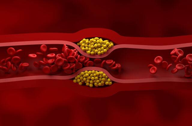 콜레스테롤은 우리 몸에 꼭 필요한 인체 구성 성분이다. 문제는 동맥경화를 일으키는 LDL콜레스테롤이 지나치게 많아질 때다. 클립아트코리아
