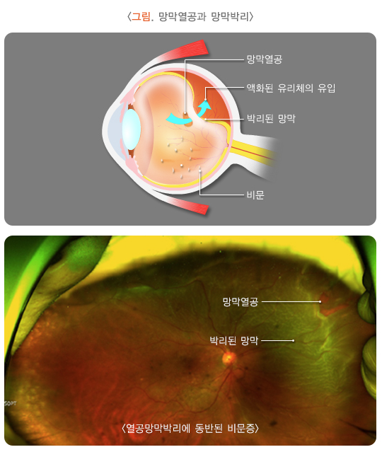 병적 비문증은 망막열공이나 망막박리, 안구 염증질환, 유리체 출혈, 안구 외상 등 치료가 필요한 안질환에 의해 발생한다. 질병관리청