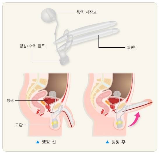 ▲음경보형물 수술은 발기부전 치료의 대안 중 하나이다. 자료=질병관리청 국가건강정보포털