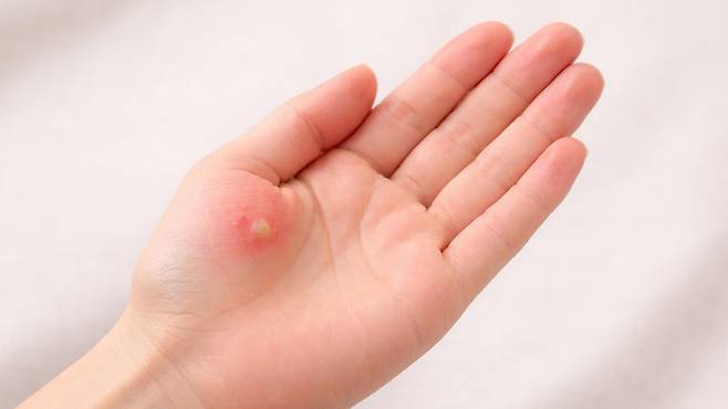 화상 치료의 핵심은 통증을 조기에 조절하고 흉터를 최소화하는 데 있다|출처: ChatGPT 생성