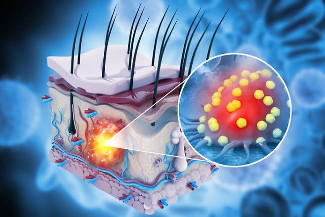 흑색종 수술 환자에게 개인 맞춤형 mRNA 백신 인티스메란과 면역항암제 펨브롤리주맙을 병용 투여하면 재발·사망 위험이 49%, 원격 전이 위험이 59% 줄고 전체 생존율이 92.2%에 달한다는 5년 추적 임상 결과가 나왔다. 게티이미지뱅크 제공