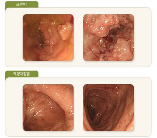 크론병(위)과 궤양성 대장염(아래) 환자의 대장을 내시경으로 찍은 사진. /사진=국가건강정보포털