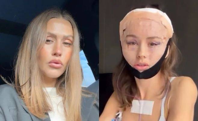 호주의 인플루언서 루비 튜즈데이 매튜스가 최근 서울의 한 성형외과에서 내시경 안면거상술을 받은 뒤 자신의 사회관계망서비스(SNS)에 수술과 회복 과정을 공개했다. 루비 튜즈데이 매튜스 인스타그램 캡처